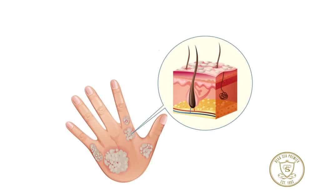 Diagram showing psoriasis on human hand illustration